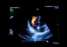 Ecocardiogramma-Color-Doppler - Cardiologia Terlizzi