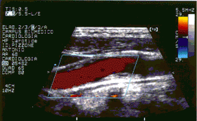 Eco-Color-Doppler Vasi del Collo - Cardiologia Terlizzi